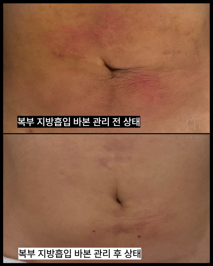  복부 지방흡입 단단함, 왜 생기고 어떻게 달라질까요? (전,후 사례 포함)