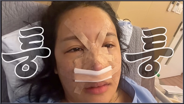 랄랄 코 재수술 3번째 후기 일주일 만에 붓기가 이 정도라고요? 비결까지 공유했어요