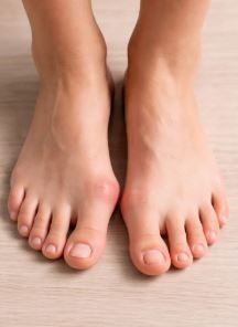 [국제테이핑] 무지외반증(Hallux Valgus)