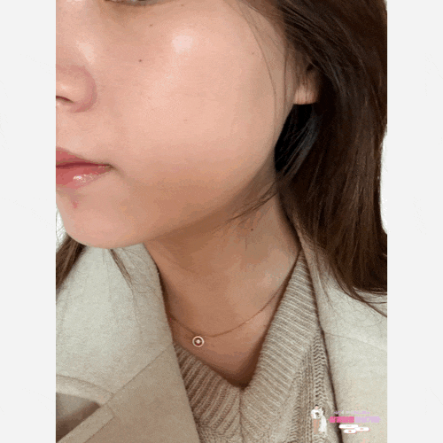  강남구청역피부과 온다 리프팅 후기 6만줄, 잘하는곳 리얼 변화