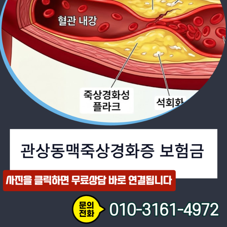  관상동맥죽상경화증 보험금, 49%면 거절 50%면 지급?