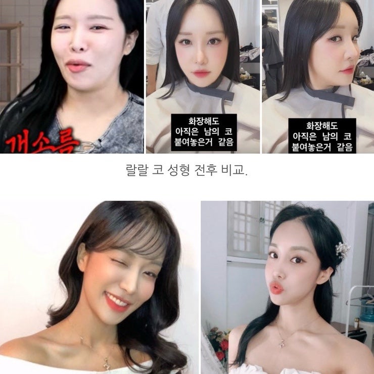 “남의 코라더니 진짜 달라졌네?” 랄랄 코 성형 전후..붓기 빠지고 분위기 바뀐 이유(병원 ....
