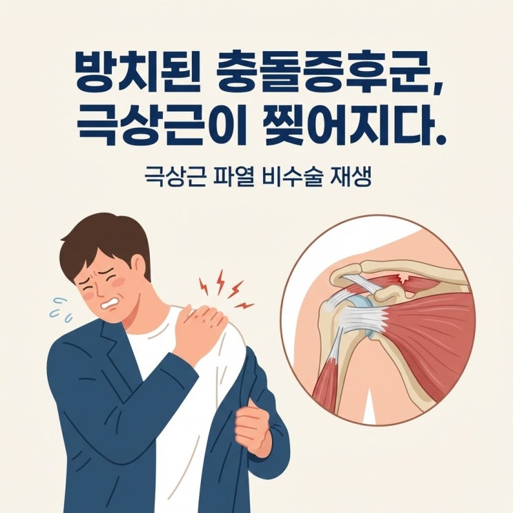 회전근개파열 어깨통증 원인, 극상근파열과 회전근개 부분 파열 치료 (어깨충돌증후군 회전근개파열 차이)