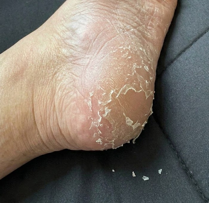 아시모토 노젠 EX 리뷰 겨울 발뒤꿈치 관리 직접 써본 장단점 정리