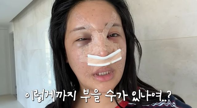  랄랄 또 성형…심각하게 부은 얼굴에 ‘딸도 기겁’ [DA클립]