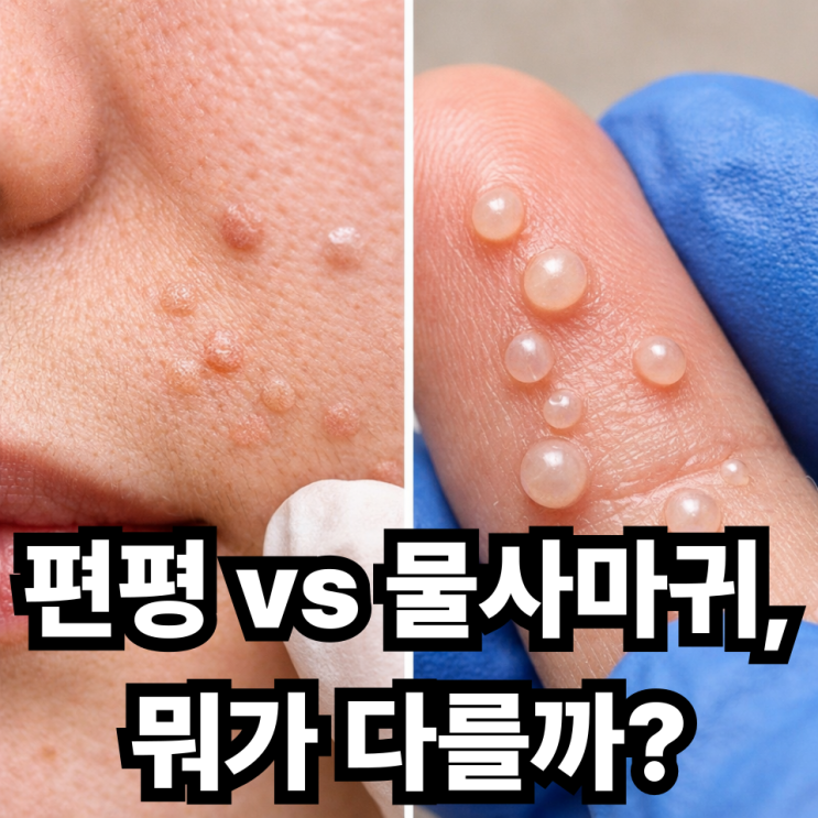  편평사마귀와 물사마귀 차이, 헷갈리지 않는 구분법 총정리