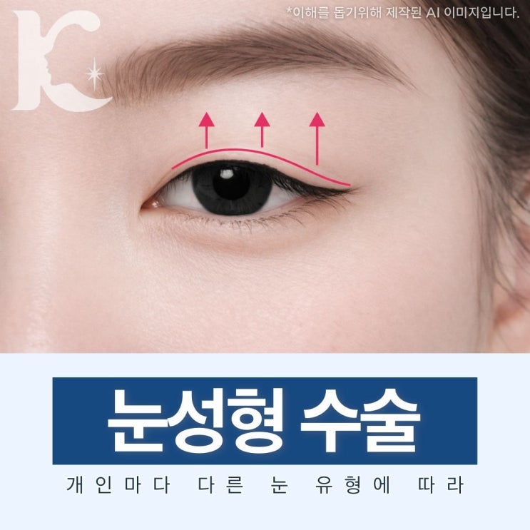  광주쌍꺼풀수술 전에 눈성형 종류 체크 안검하수 눈매교정과 상안검에 대해