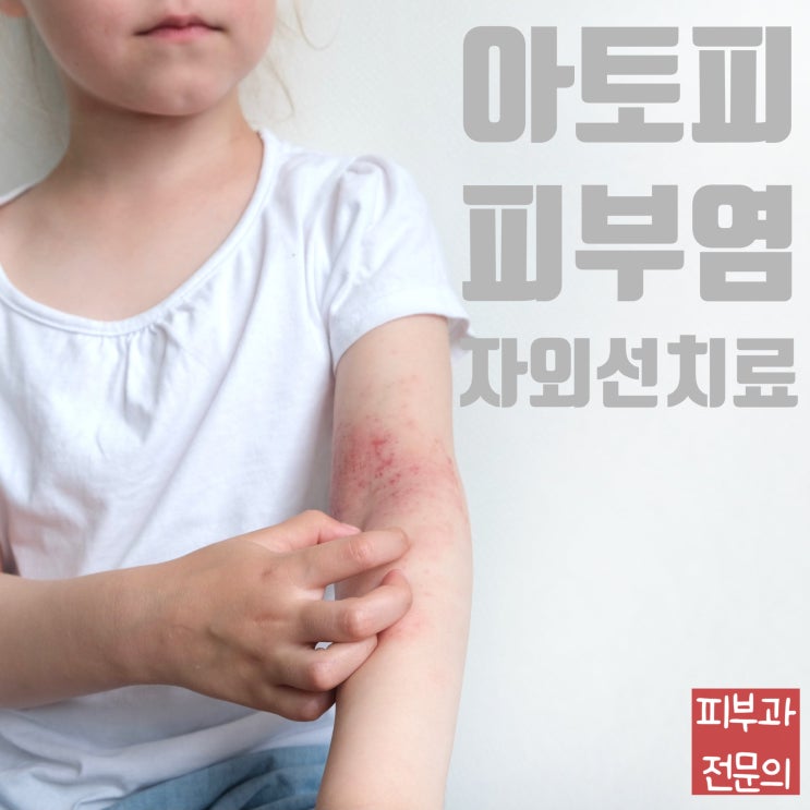  아토피피부염의 치료는? 2편 자외선치료