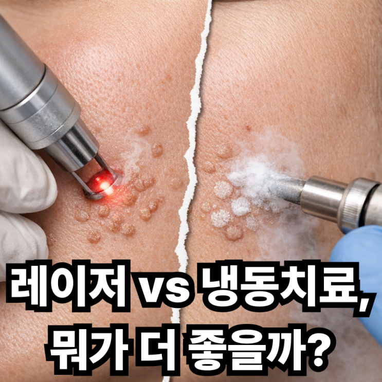  편평사마귀 제거 방법 비교, 레이저 vs 냉동치료 어떤 게 나을까?
