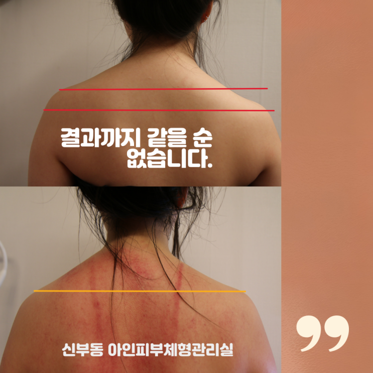  천안피부관리 신부동피부관리 승모근관리와 어깨관리의 차이점 얼굴라인 달라지는 이유