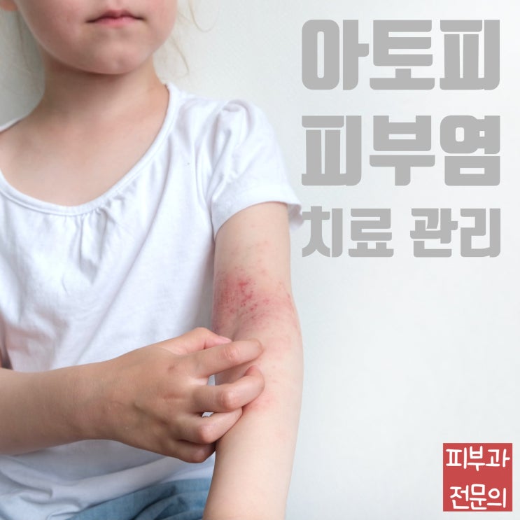  아토피피부염의 치료는? 1편 (바르는약/먹는약)