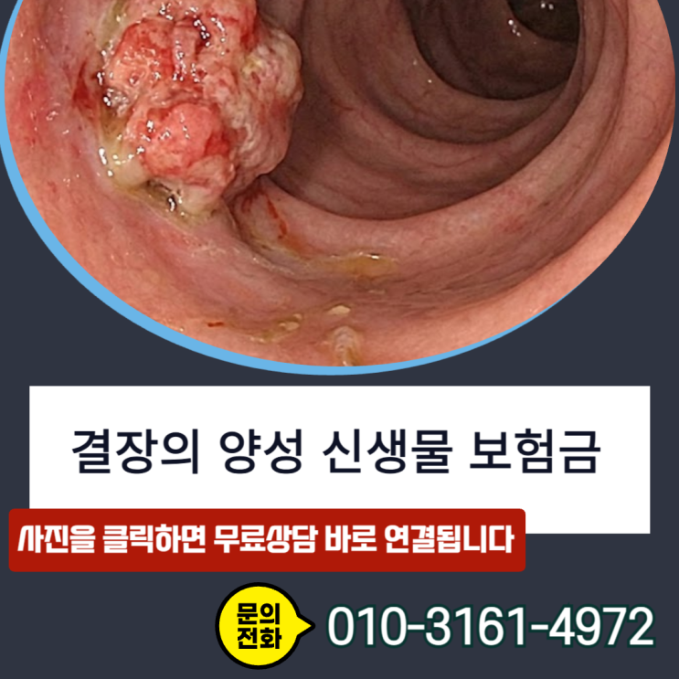  결장의 양성 신생물, D12.6이라 거절됐나요? 제자리암 인정되는 결정적 이유