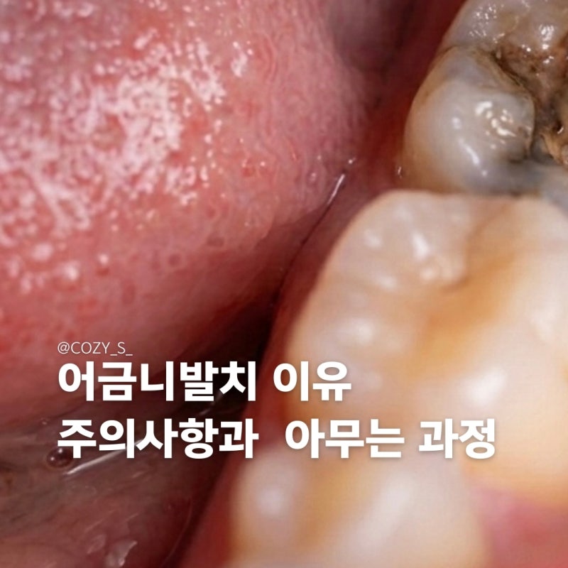 어금니 발치 이유와 과정 통증 주의사항 아물기까지