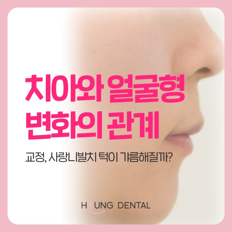  교정 후 턱이 갸름해진다? 수원교정치과가 알려주는 진실