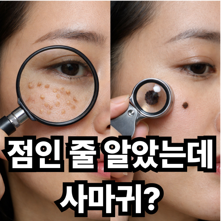  얼굴에 생긴 편평사마귀, 점과 구별하는 방법 한눈에 정리