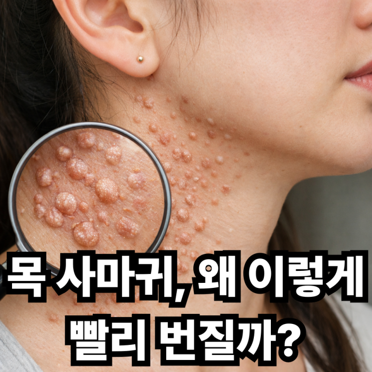  목에 번지는 편평사마귀, 왜 빠르게 퍼질까? 원인과 대처법