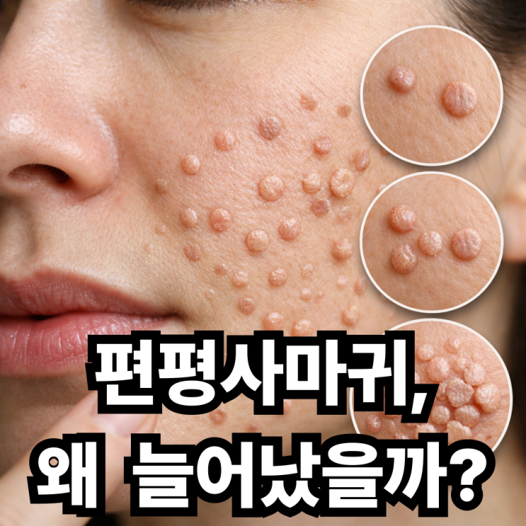  편평사마귀 갑자기 늘어나는 이유  한두 개였는데 왜 이렇게 많아졌을까?