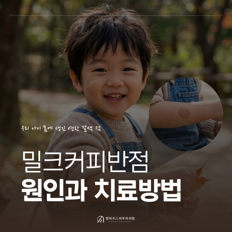  아기갈색점, 밀크커피반점 원인과 치료방법
