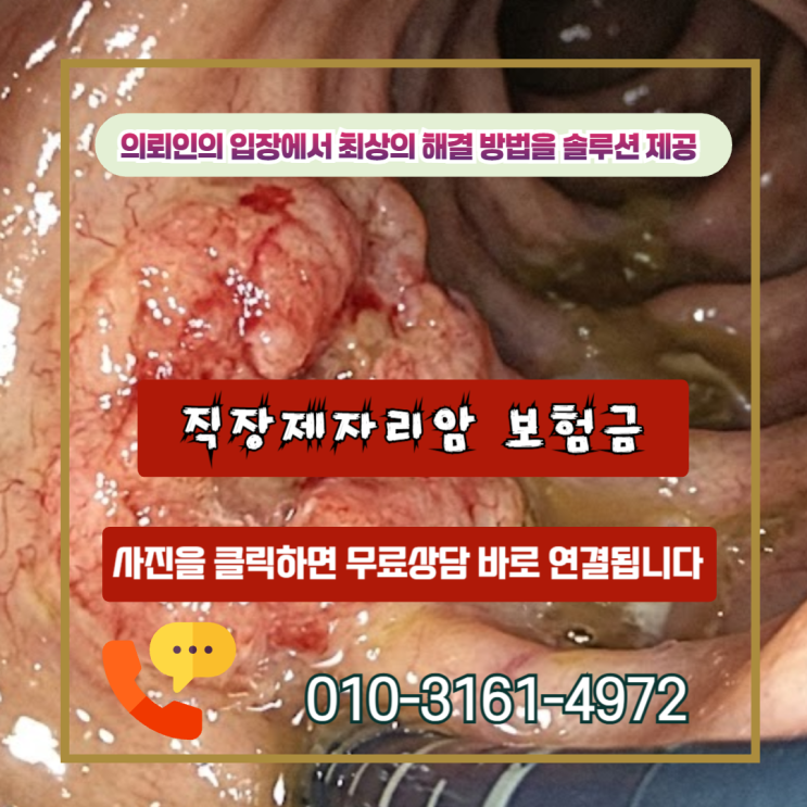  직장제자리암 보험금, D12.8 용종이라 거절? 암 진단비 받을 수 있습니다