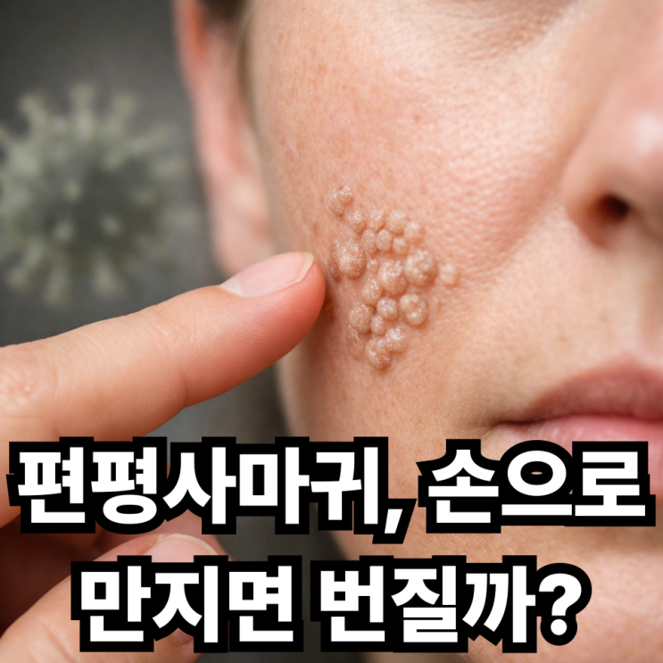  편평사마귀 손으로 만지면 위험할까?  괜히 건드렸다가 번질 수도