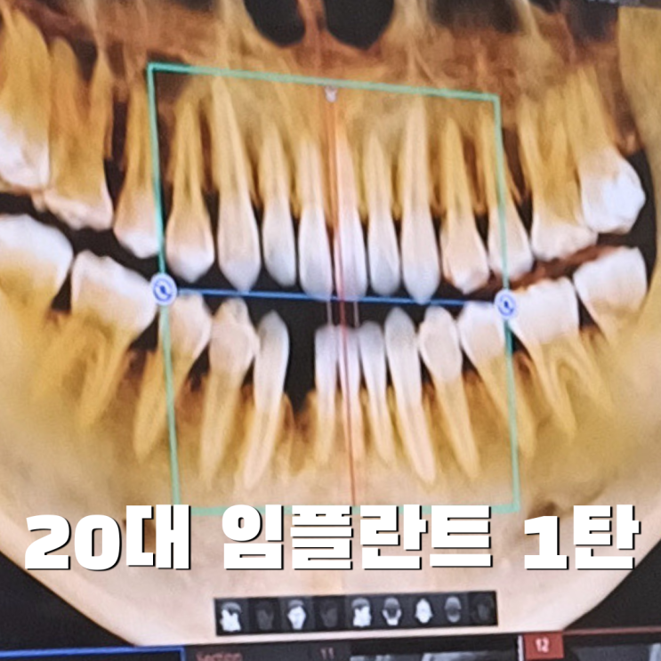 20대 임플란트 후기 1탄 | 24살에 임플란트 하게 된 썰 푼다