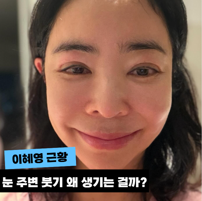 이혜영 폐암 이겨냈는데 또 건강 문제...“눈 주위 림프” 무슨 일인....