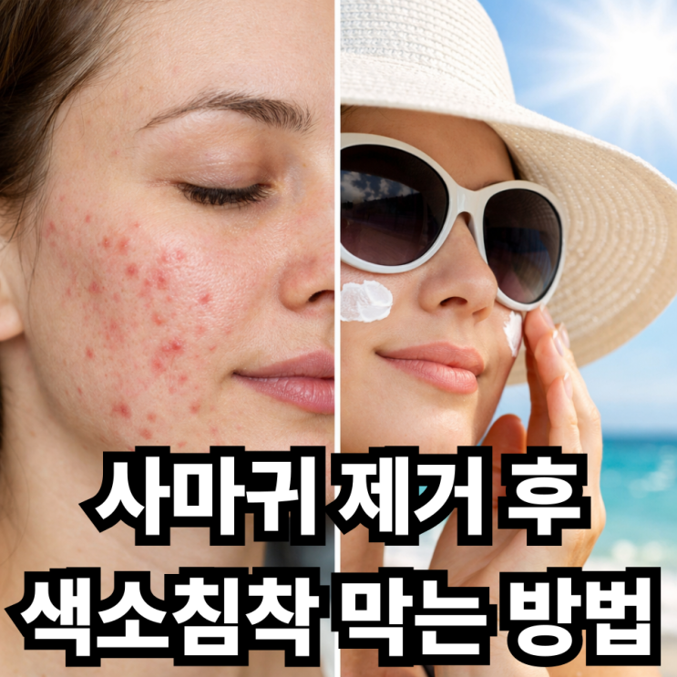  편평사마귀 제거 후 자외선 차단이 중요한 이유  색소침착 막는 핵심 관리법