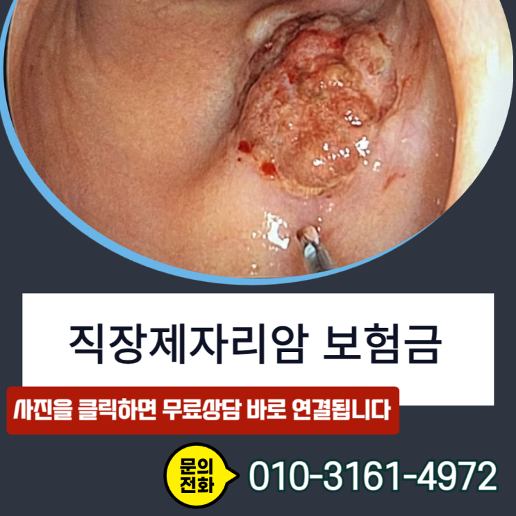  직장제자리암 보험금, D12.8 용종이라 거절? 고등급 이형성증이면 전액 지급됩니다