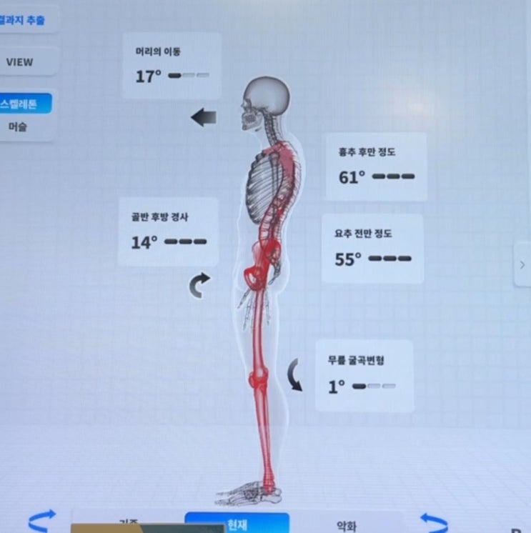  분당체형교정 바디밸런스 PT 재활운동부터 굽은등펴기까지!