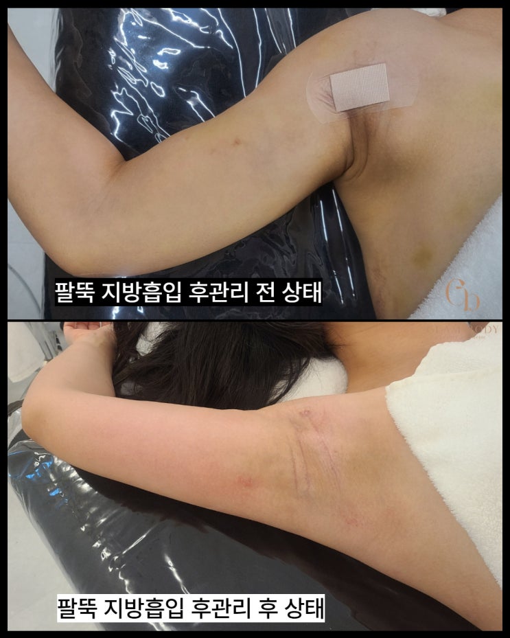  팔뚝 지방흡입 통증 언제까지 갈까요?