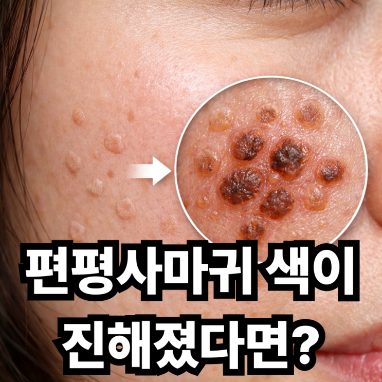  편평사마귀 색이 진해지는 이유  갑자기 갈색으로 변했다면?