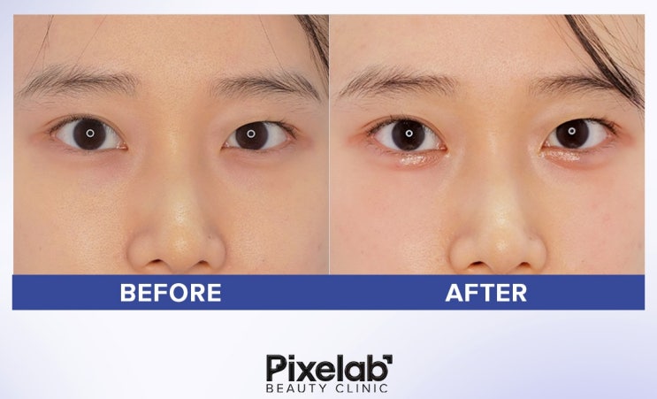  애교필러 녹이기, 무작정 주사부터 맞지 마세요. 성형외과 전문의가 확인하는 3가지 판단 기준