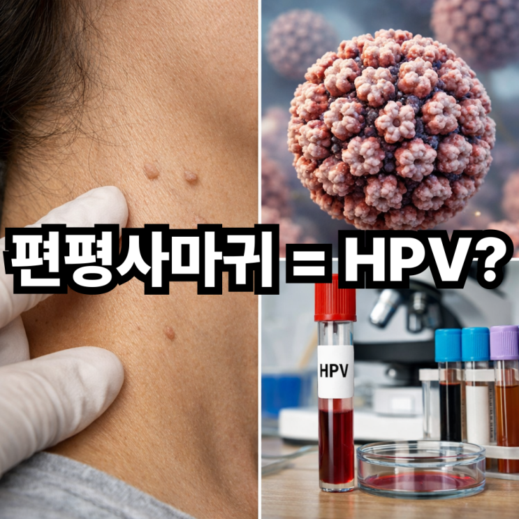  편평사마귀와 HPV 관계 정리  바이러스가 원인일까?
