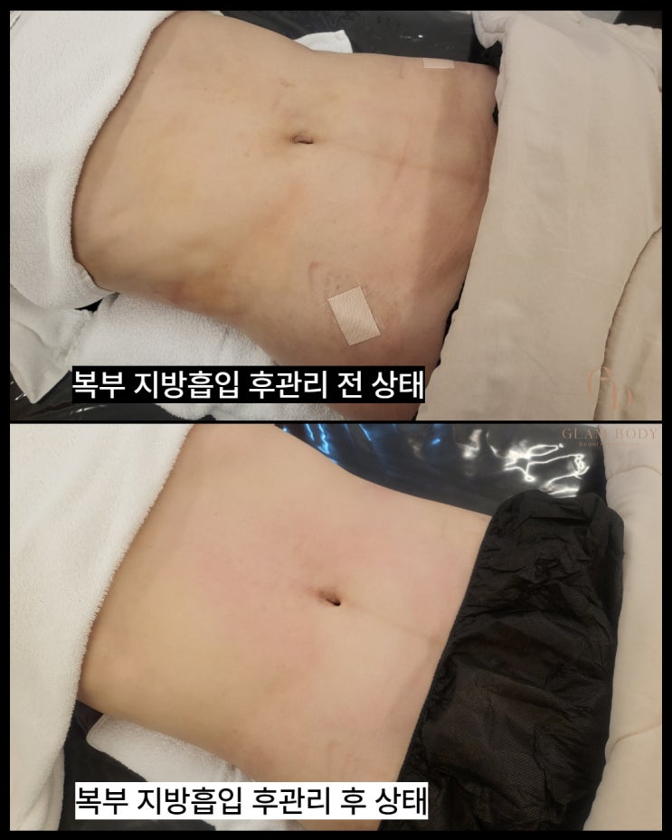  지방흡입 2주차, 왜 더 딱딱해질까요? 붓기와 바본 변화