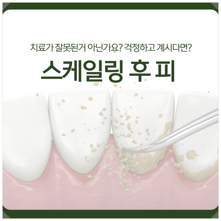 스케일링 후 피, 치료가 잘못된거 아닌가요? 걱정하고 계신다면?