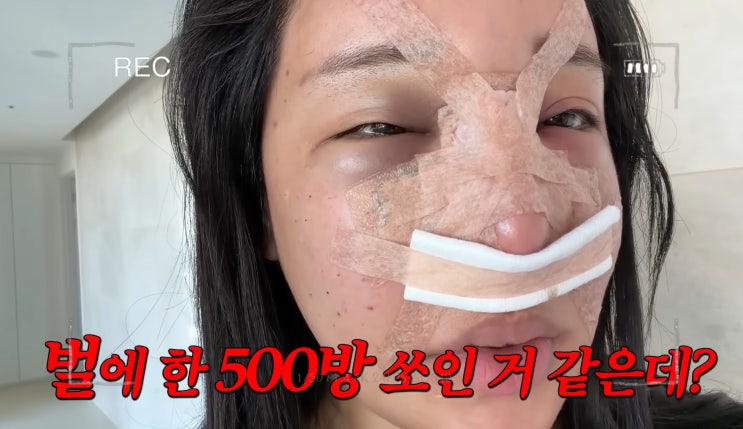  얼굴 붓기만 쏙 빠져도 성공? 랄랄 코 눈밑지방 재배치 회복기 (성형외과 병원 정보는)