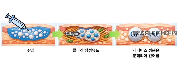 써마지하면 볼꺼짐도 채워지나요