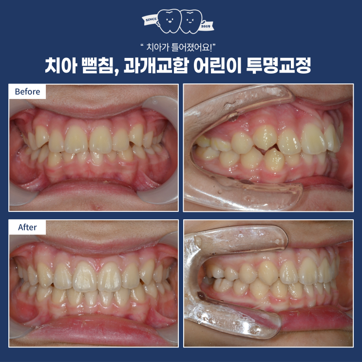  어린이 치아교정 시기, 유치 남아있어도 ‘인비절라인 퍼스트’가 가능한 이유