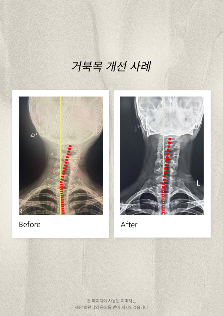  오산세마역 필라테스 린                          거북목 자세, 생각보다 많은 분이    가지고 있습니다