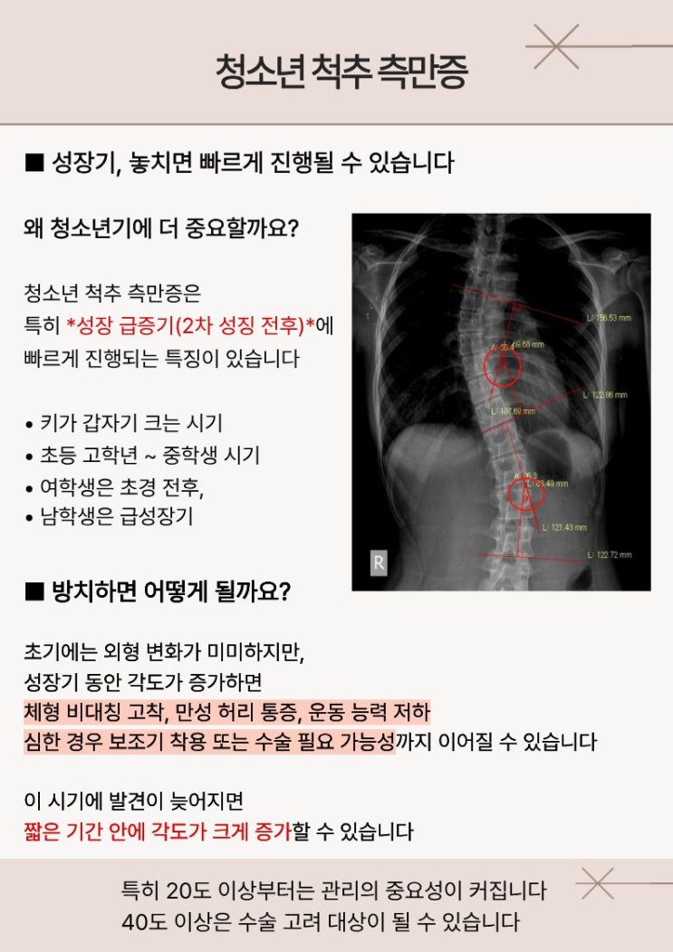  오산세마역 필라테스 린                          청소년 척추측만증, 성장기라면   더 중요할 수 있습니다