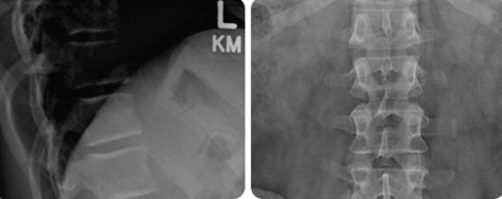 허리디스크 검사 뭐 찍어야 할까? X-ray, CT, MRI 차이점