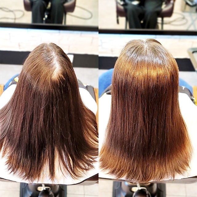  용인에서 오신 고객님 뒤통수 갈라짐 고민, 가마까지 휑해 보이는데 링거펌 모류교정으로 해결될까요?