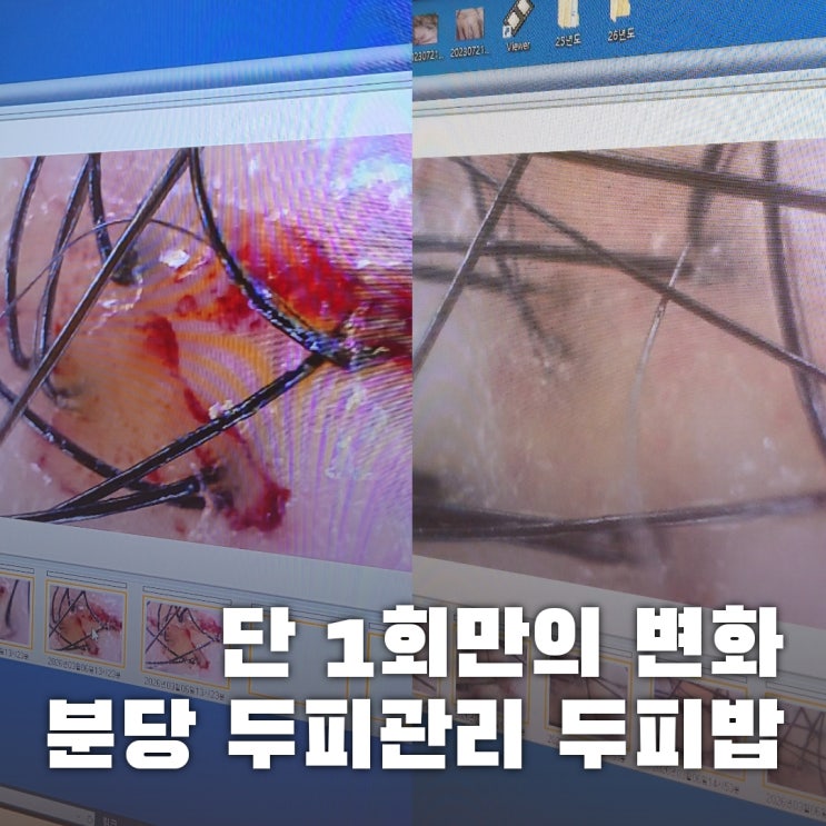  분당 두피 케어 두피밥 | 지루성 맞춤 관리 스케일링 후기