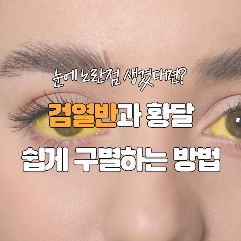 눈에 노란 점이 생겼다면? 검열반과 황달 구별하는 가장 쉬운 방법
