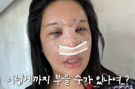 "누구세요?" 코성형한 랄랄, 남편도 놀랄 충격적인 비주얼 변화