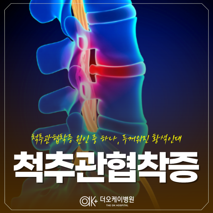  춘천 척추관협착증 원인 중 하나, 두꺼워진 황색인대?