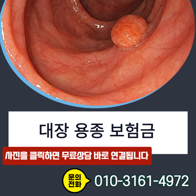  대장 용종 보험금, D12.6 양성 코드라도 제자리암 진단비 받을 수 있습니다
