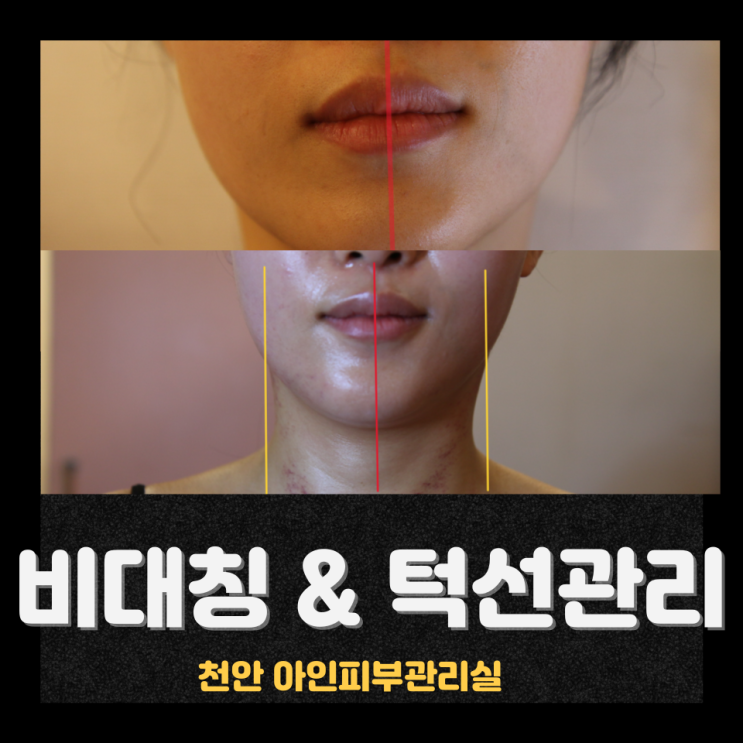  작은얼굴 만들기 얼굴이 커 보이는 이유와 얼굴 헤리티지 윤곽관리 방법｜천안 신부동 피부관리
