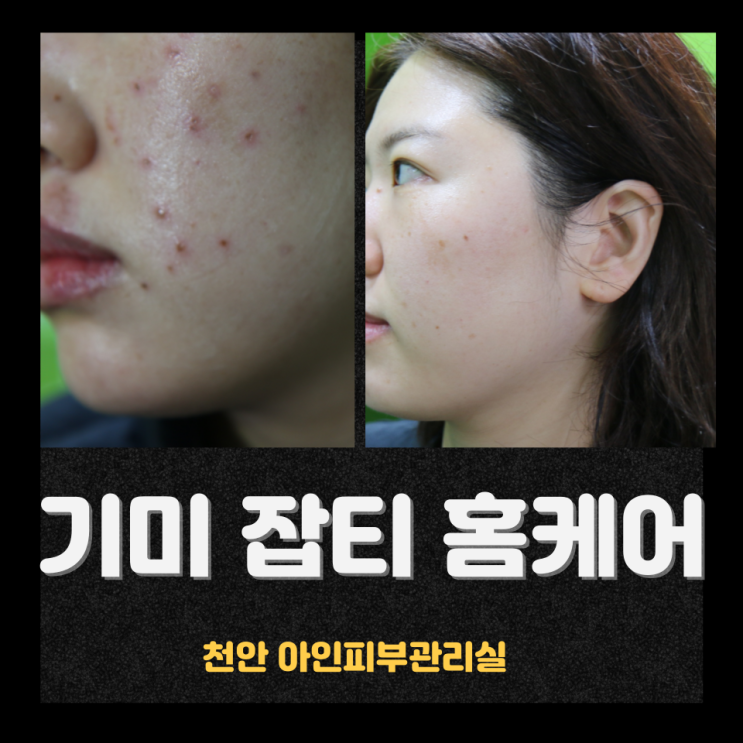  기미 잡티가 사라지지 않는 이유 기미 잡티 홈케어 관리방법 천안 신부동 아인 피부관리