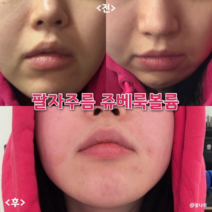  명동피부과에서 필러 대신 쥬베룩볼륨으로 팔자주름 관리하기